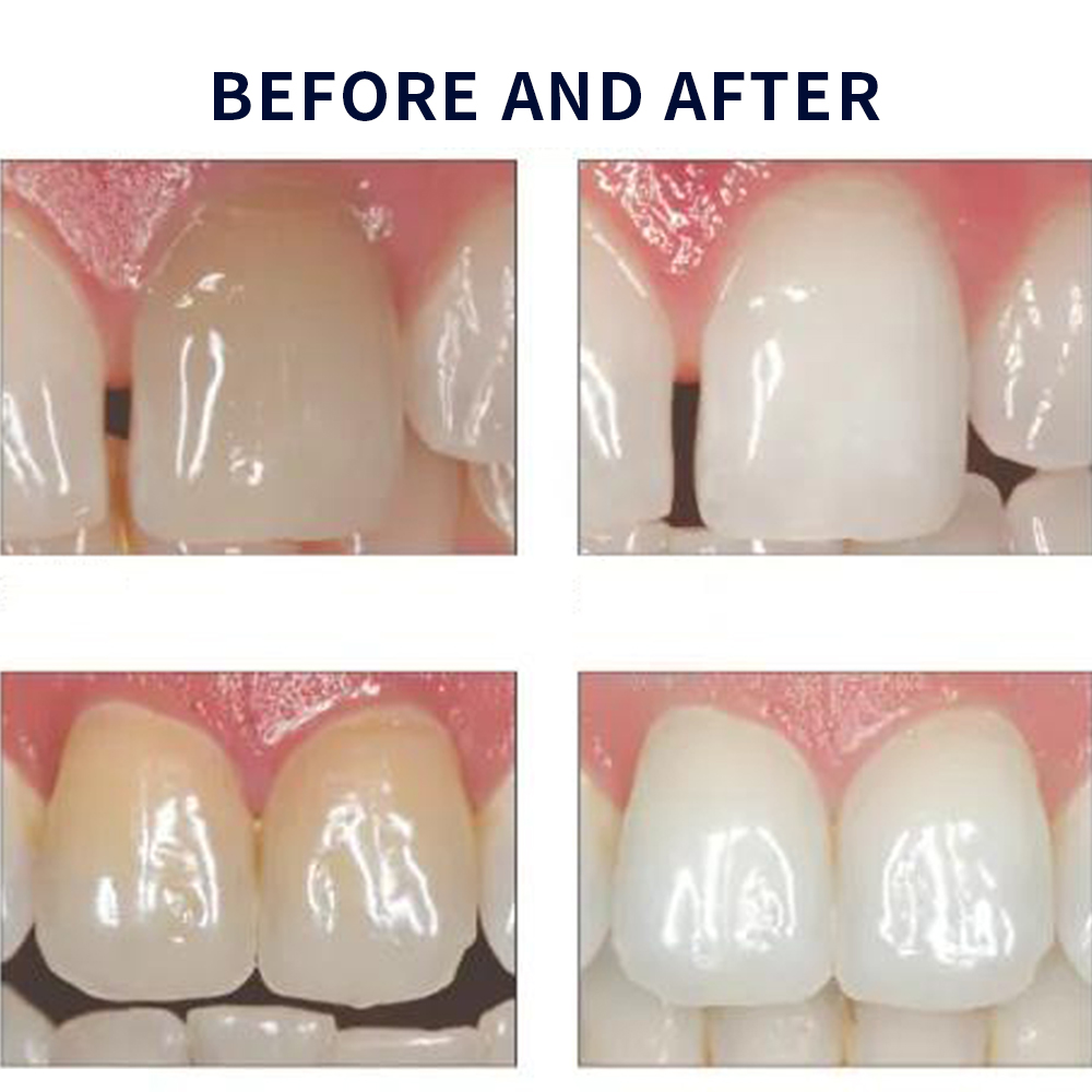 유백광 미백 20% PF 20 16 젤 키트, 초강력  - Teeth Whitening Near Me 리뷰 및 가격