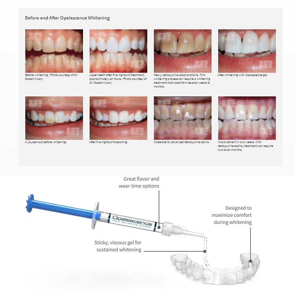 유백광 미백 20% PF 20 16 젤 키트, 초강력  - Teeth Whitening Near Me 리뷰 및 가격